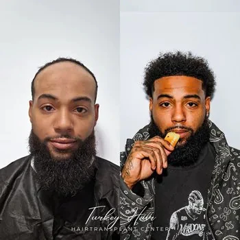 Why Afro Hair Transplant Requires Specialized Expertise