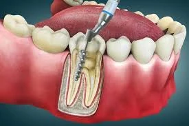 Dental Pulp Treatment: Simple Ways to Prevent Retreatment