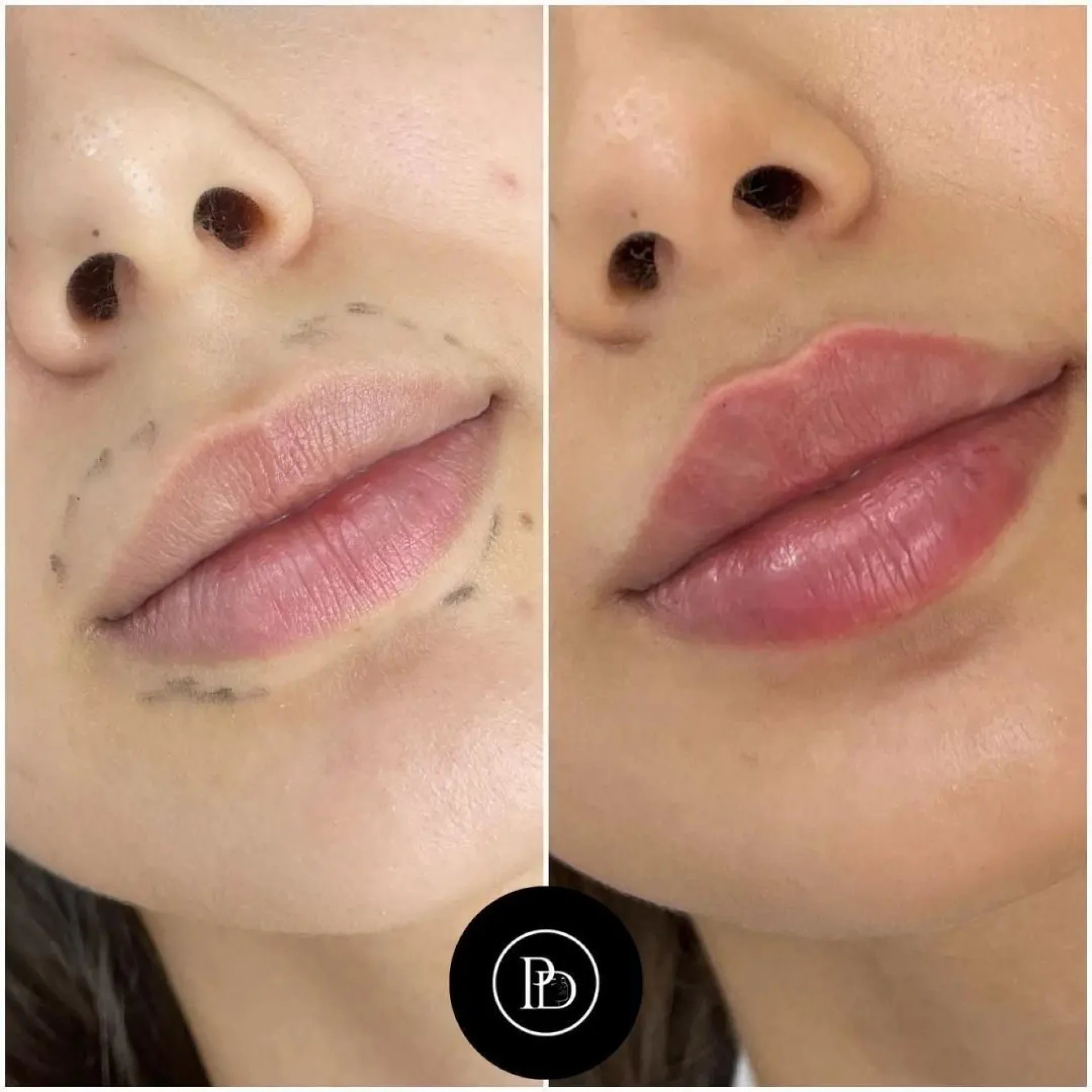 Are Juvederm Treatments in Dubai Worth It?