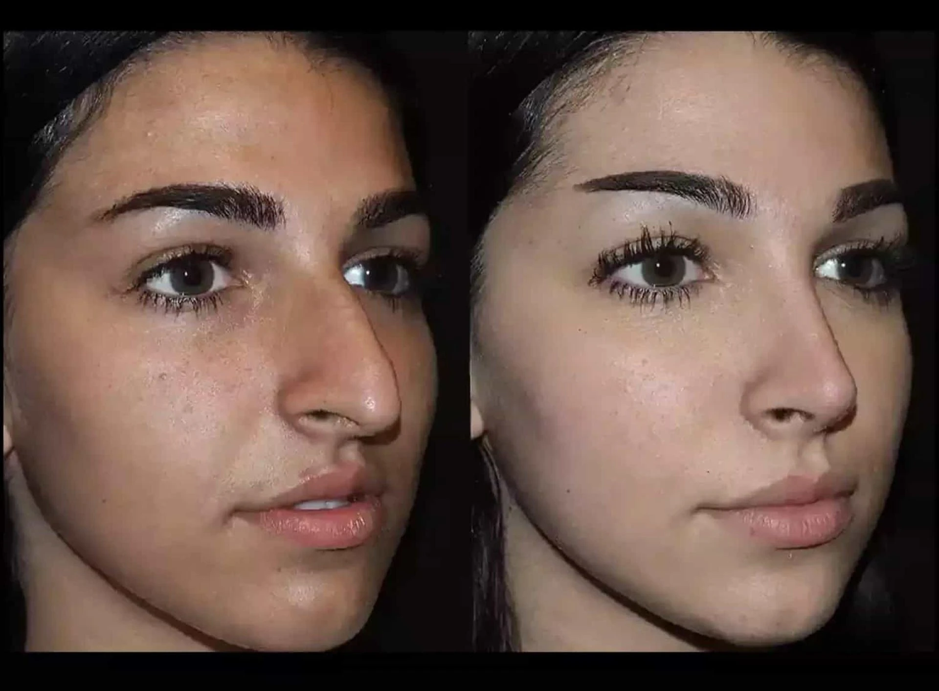 Evaluating Nose Deviated Septum Surgery in Dubai for Functional Relief
