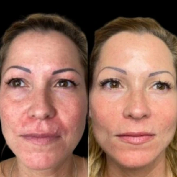 Skin Clarity using Profhilo at the Best Aesthetic Clinic in dubai