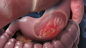How Early Diagnosis Improves Stomach Cancer Survival Rates?