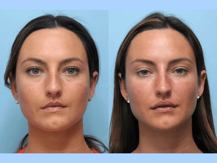 Quick Safe and Impressive Thread Lift Results by the Best Doctors in Dubai