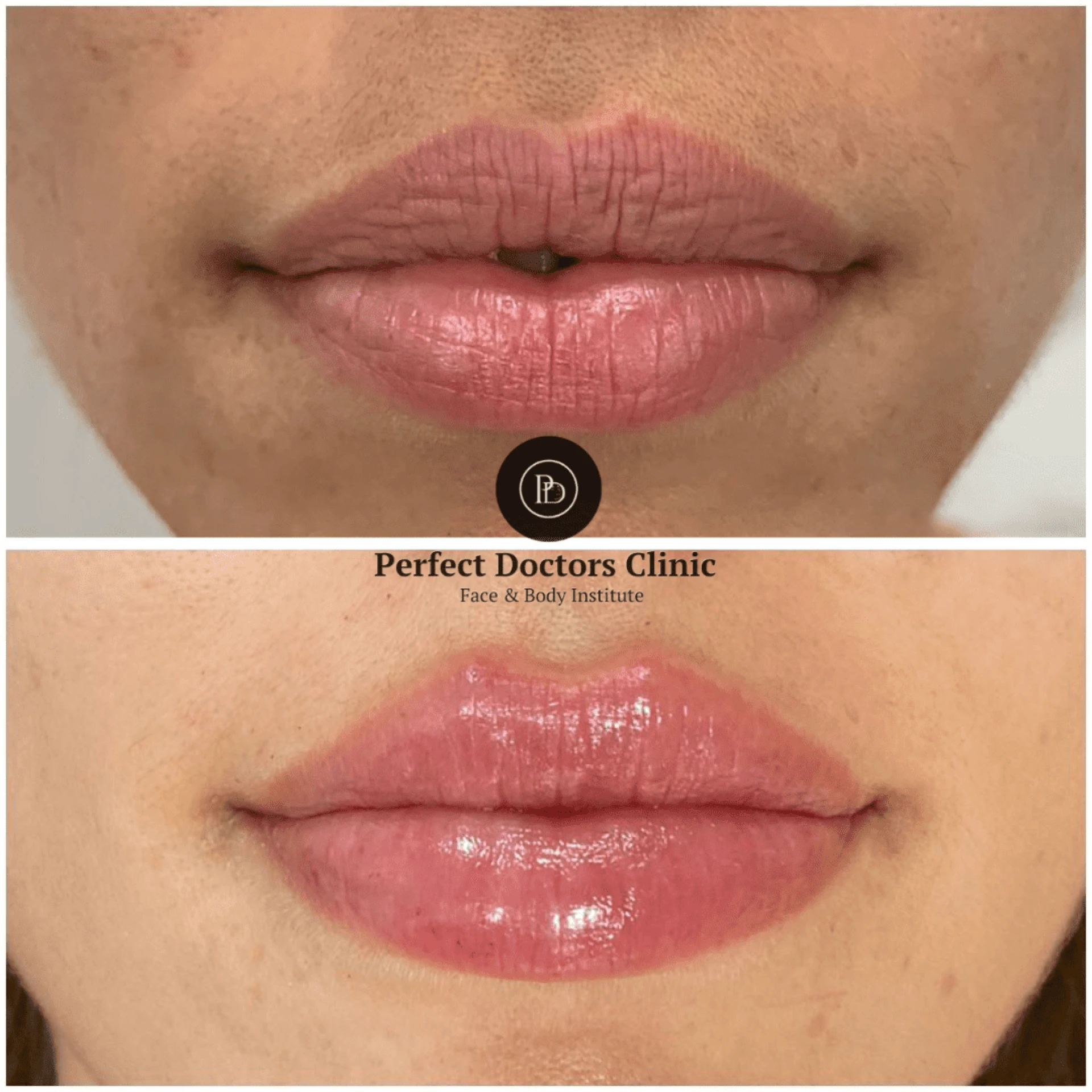 Juvederm for Preventative Aging by the Best Plastic Surgeon in Dubai