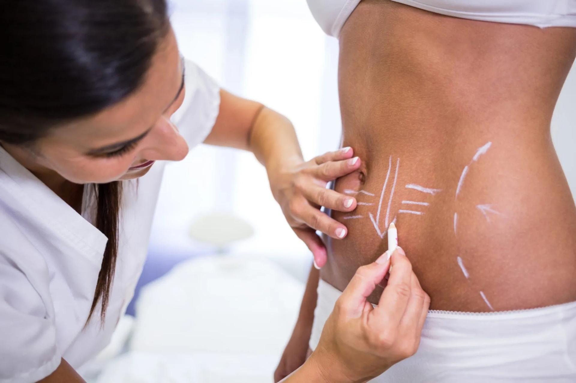Tummy Tuck in Islamabad – Get Back Your Pre-Baby Body