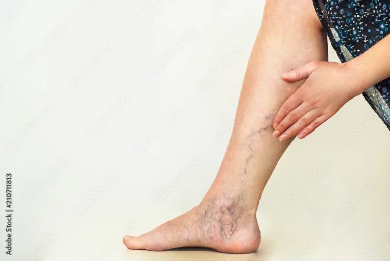 Endovascular Surgeon UAE for Advanced Vein Treatment